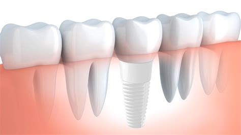  Ossido di Zirconia: Biocompatibilità e Resistenza per Impianti Dentali di Alta Qualità!